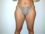 Liposuction, Ya Aldrma Ameliyat ncesi