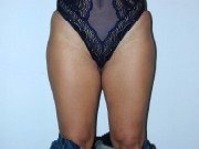 Liposuction, Ya Aldrma Ameliyat ncesi